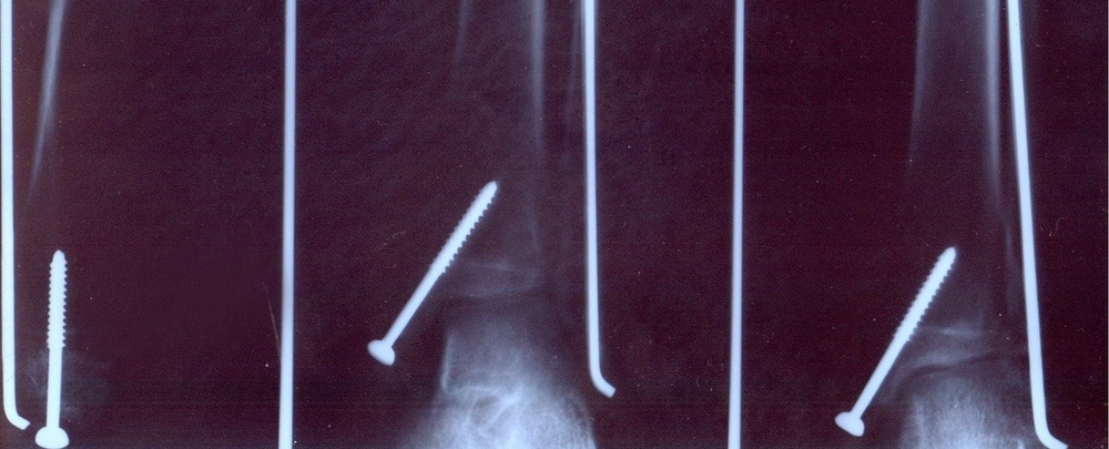 Broken leg x ray with screws inside-656350-edited.jpeg